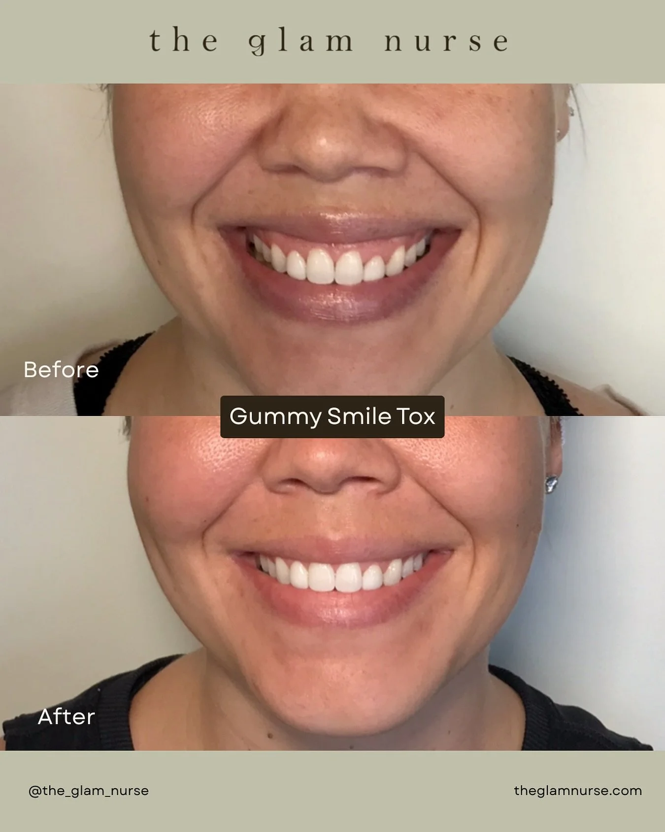 One of our favorite types of transformations 👄simple, subtle, and confidence-boosting. This before &amp; after shows how carefully placed tox can help reduce the appearance of a gummy smile, creating a more balanced smile while still looking complet