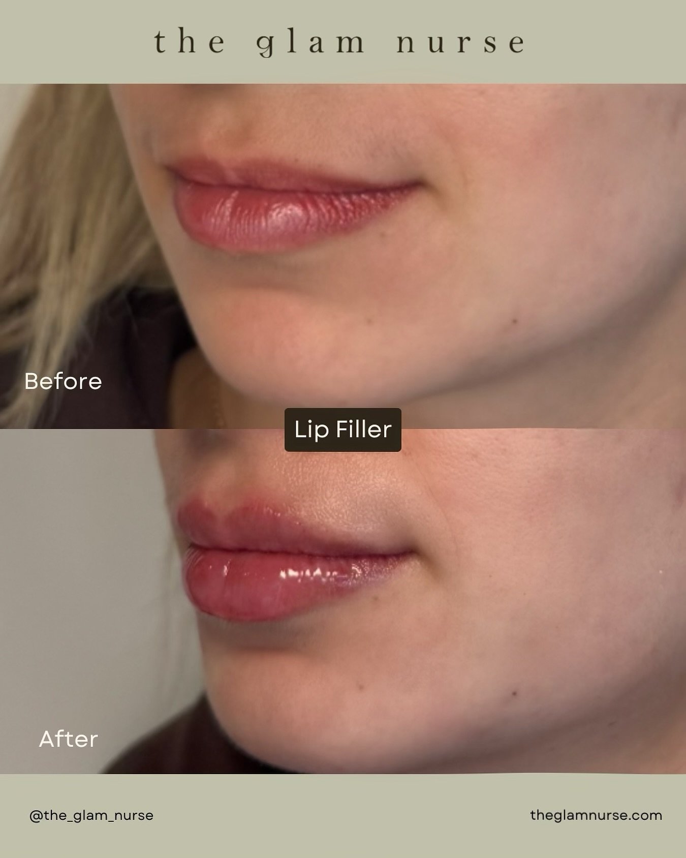 New year, new lips! 💋
A touch of volume and vertical height to enhance what was already there 💉👄

We are currently scheduling into January, so please plan your appointments ahead😉

Please note swelling, bruising and slight unevenness is normal an