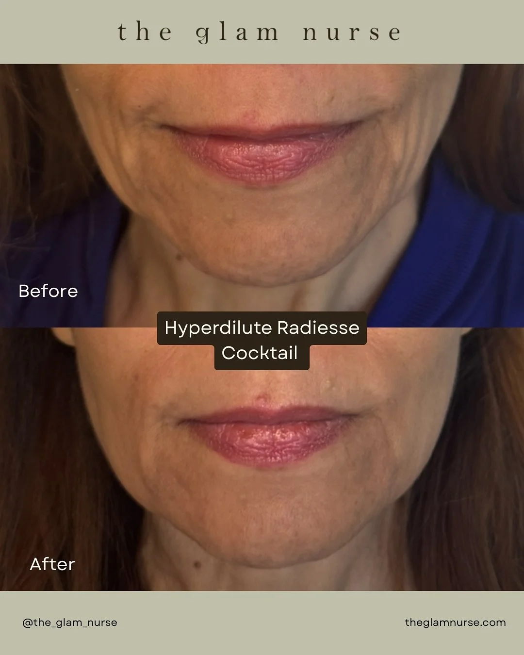 Woweee!!! Before ➡️ After (4 weeks later) 
✨ Needless to say We 💗 regenerative medicine

Hyperdilute Radiesse Cocktail = instant results plus long-term collagen stimulation! It&rsquo;s a favorite treatment for almost anyone all over the body bc it i