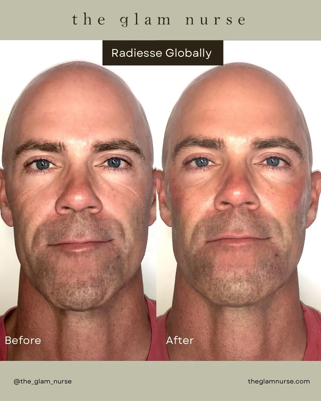 Before &amp; After ✨
This patient was treated with Radiesse globally strategically placed to restore volume exactly where it was needed. By supporting the midface, enhancing structural contours, and strengthening the lower face, we achieved a more ba