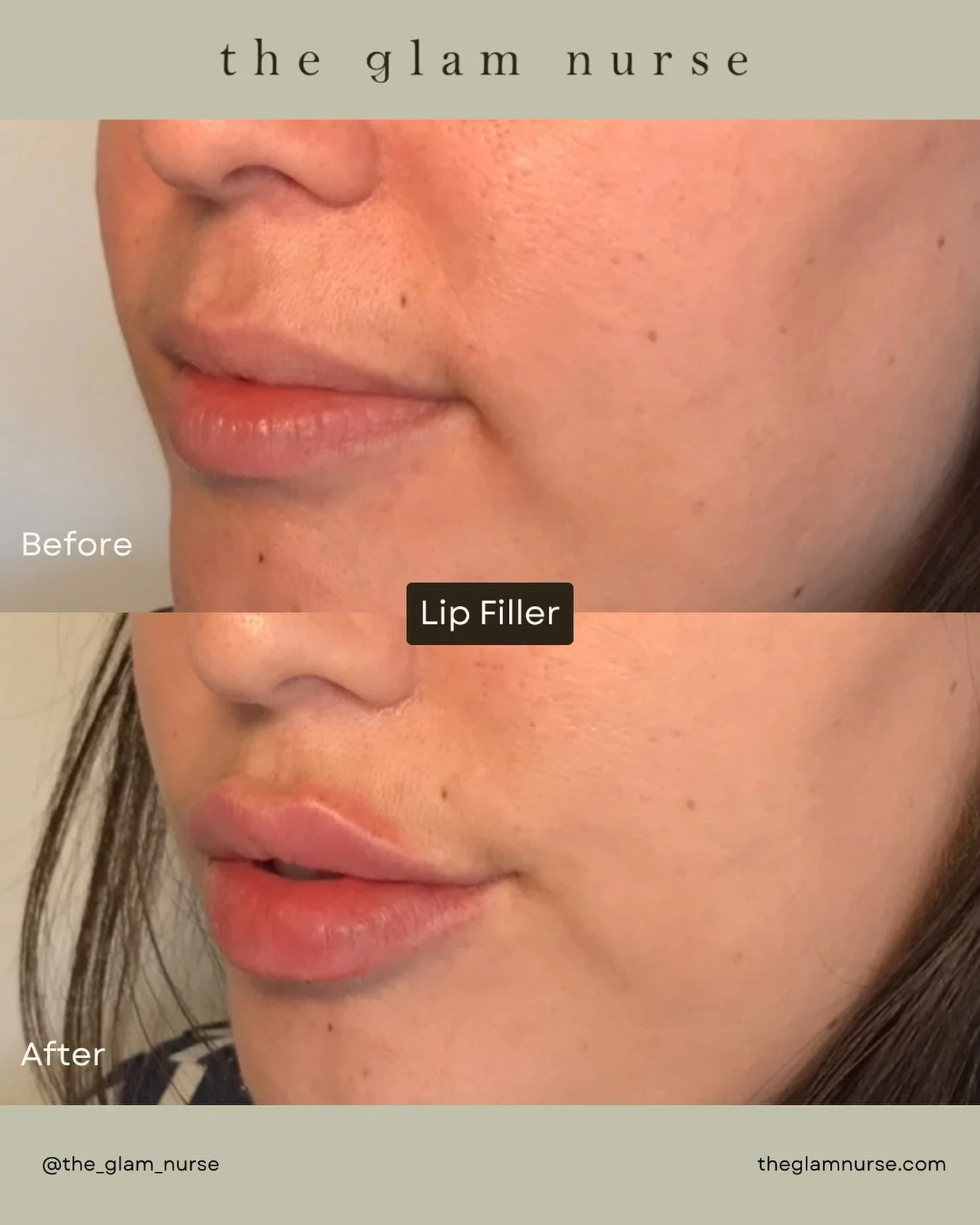 Love at first pout 💘💋
A touch of filler for added height, hydration, and a soft, natural plump ✨

We are currently scheduling into March, so please plan your appointments ahead😉

Please note swelling, bruising and slight unevenness is normal and e