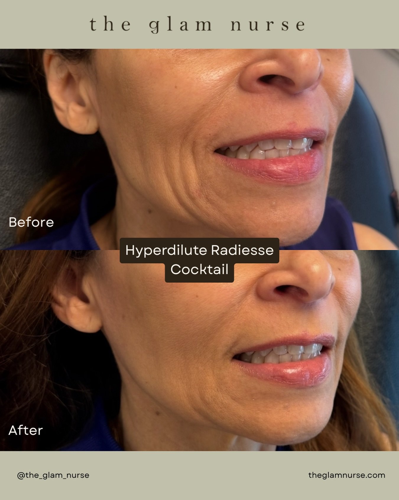 Needless to say&hellip; we &hearts;️ regenerative medicine.

Our Hyperdilute Radiesse&reg; cocktail delivers the best of both worlds &mdash;
✨ immediate visible improvement
✨ long-term collagen stimulation

This treatment enhances skin quality by sti