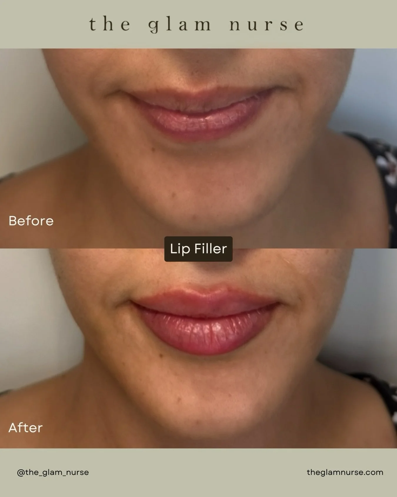 A little volume, a lot of confidence 💋✨ Lip filler tailored for balance and symmetry 💉⚖️

We are currently scheduling into March, so please plan your appointments ahead😉

Please note swelling, bruising and slight unevenness is normal and expected.