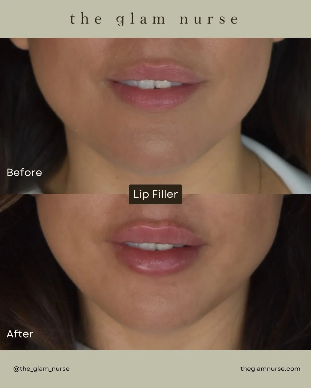 A subtle refresh 💉💋
Before ➡️ After
Balanced, hydrated, and naturally fuller lips 👄 

We are currently scheduling into April, so please plan your appointments ahead😉

Please note swelling, bruising and slight unevenness is normal and expected. Pl
