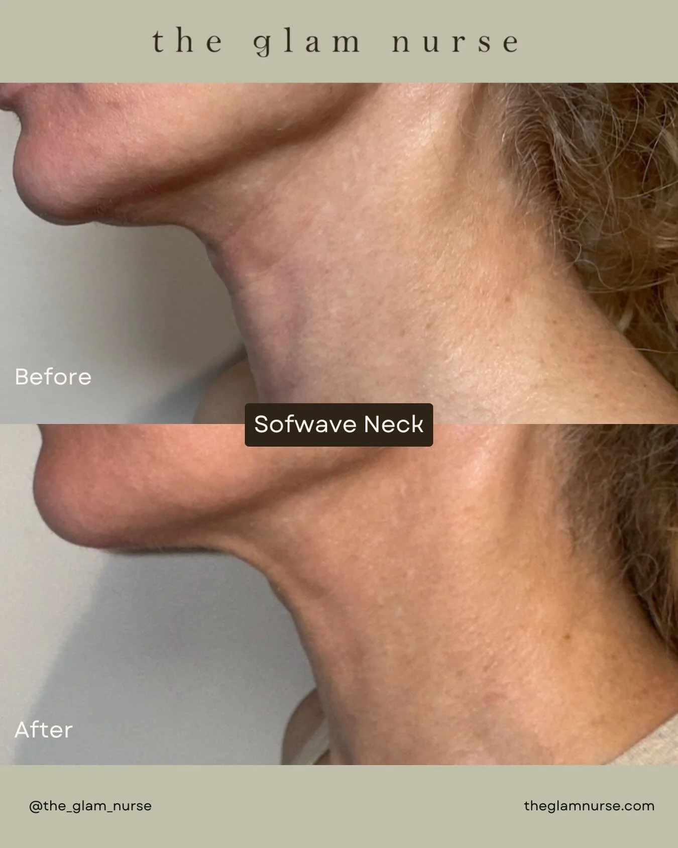 Check out this incredible result after just ONE Sofwave&trade; treatment on this beautiful patient&rsquo;s neck! ✨ @sofwavemed 

You can already see:
&bull; Softening of necklace lines
&bull; Firmer, smoother skin
&bull; A beautifully tightened under