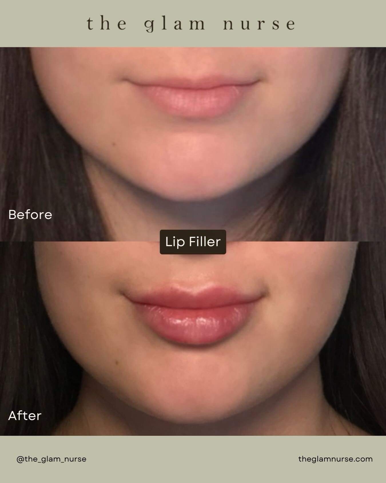 Who doesn&rsquo;t love a little lip refresh👄💉

We are currently scheduling into April, so please plan your appointments ahead😉

Please note swelling, bruising and slight unevenness is normal and expected. Plan your appointment accordingly allowing