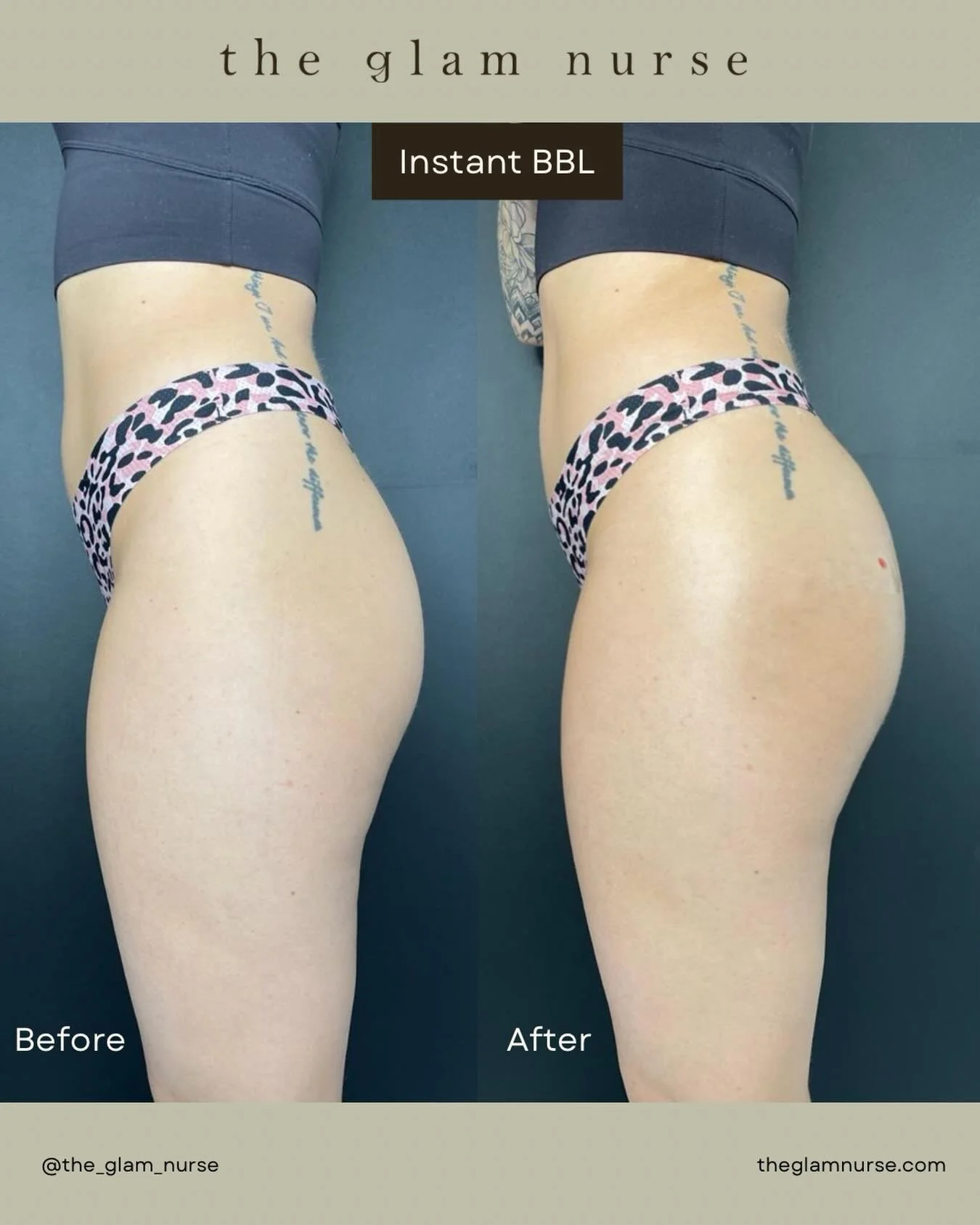 Summer is almost here&mdash;and there&rsquo;s still time to get your bikini body glowing with confidence ☀️🍑

Introducing Radiesse Instant BBL ✨
A nonsurgical alternative to a traditional BBL&mdash;no downtime, no surgery, no added risk.

This treat