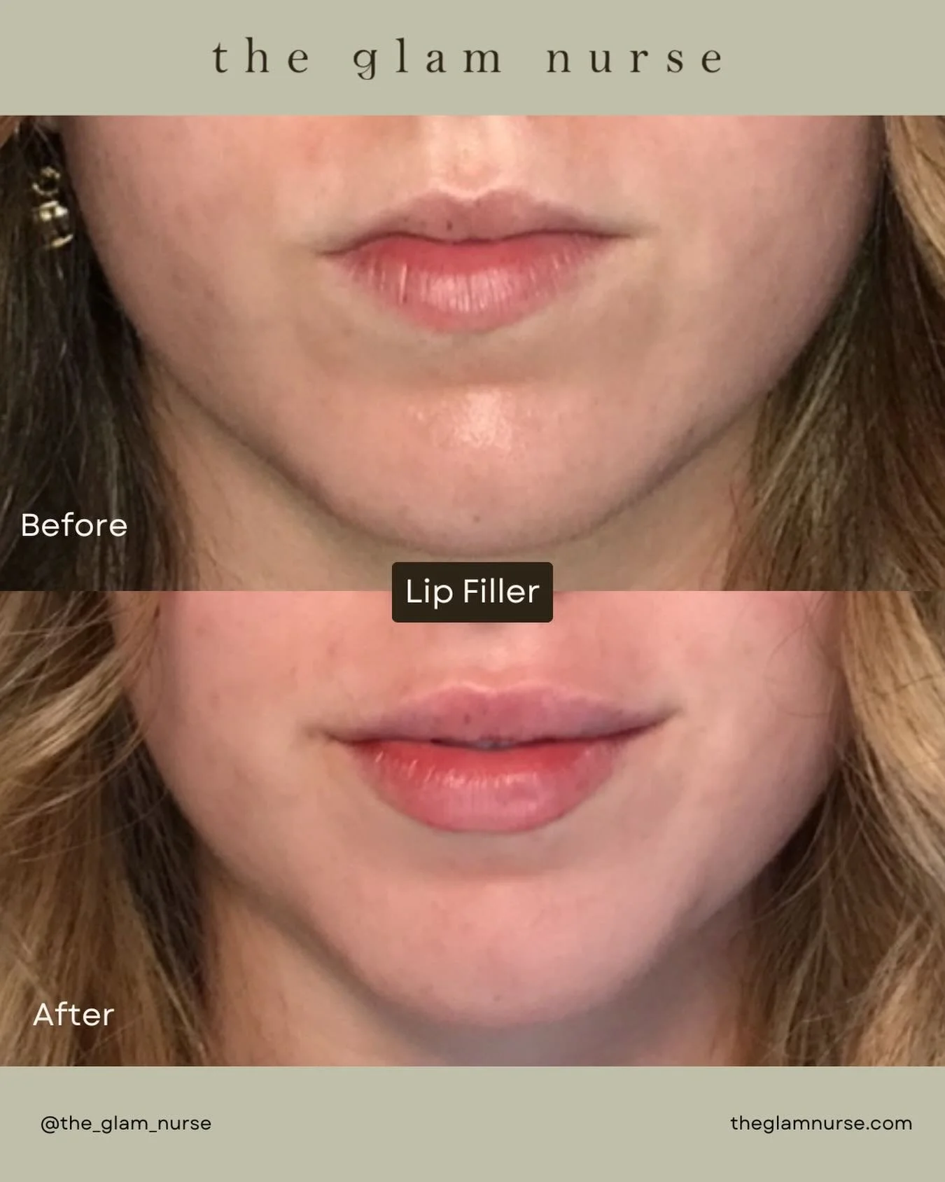 Spring glow-up in full bloom 🌸 👄💉

We are currently scheduling into April, so please plan your appointments ahead 😉

Please note swelling, bruising and slight unevenness is normal and expected. Plan your appointment accordingly allowing yourself 