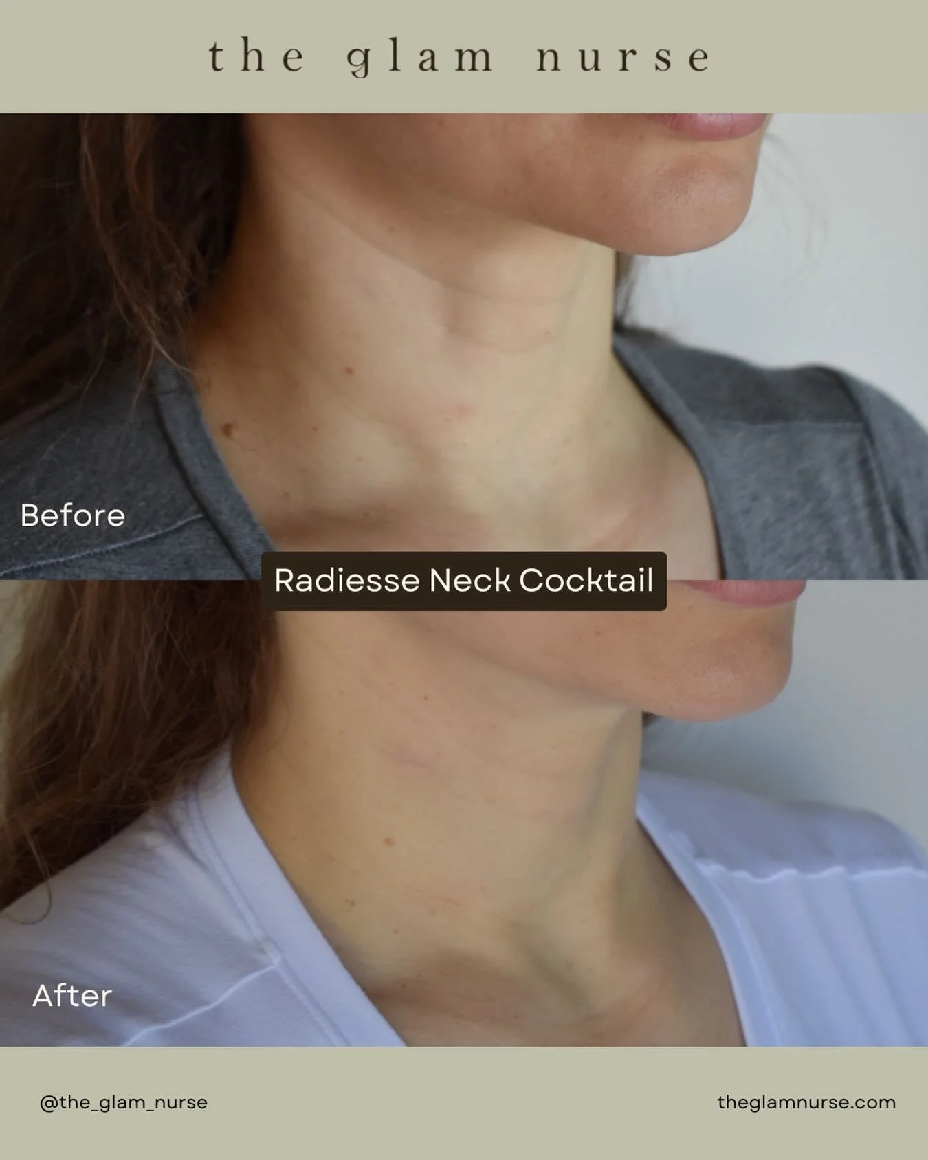 Turn back time with our signature Radiesse Cocktail! This beautiful patient wanted to improve the lines on her neck and we did just that! ✨

We love Radiesse for the best of both worlds, instant results that keep getting better with time.💉

When you