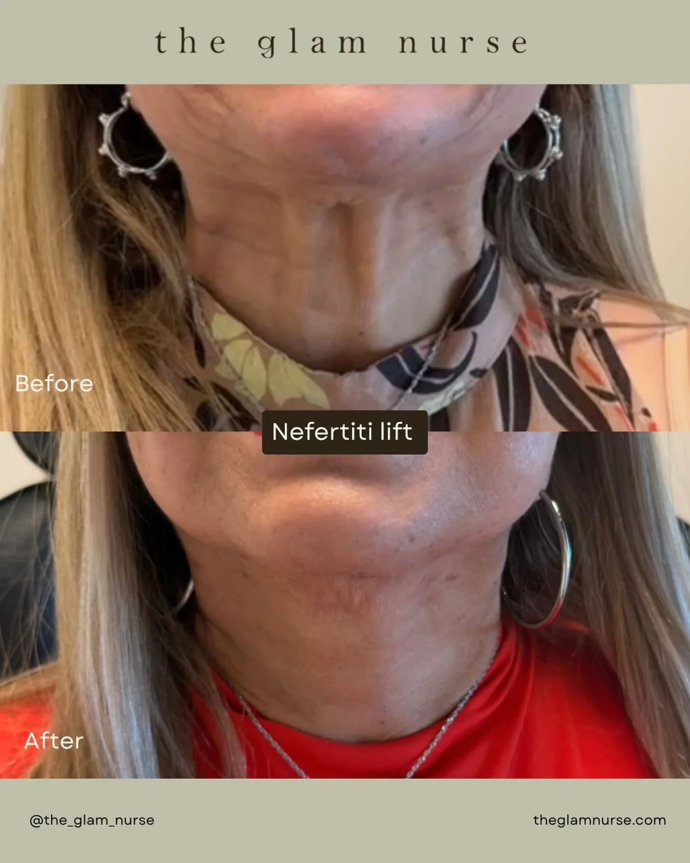 Snatched without surgery ✨

This before &amp; after shows the power of the Nefertiti Lift&mdash;strategically placed Botox to relax the lower face and neck, soften tension, and create a smoother, more lifted jawline.📐

No downtime. No filters. Just 