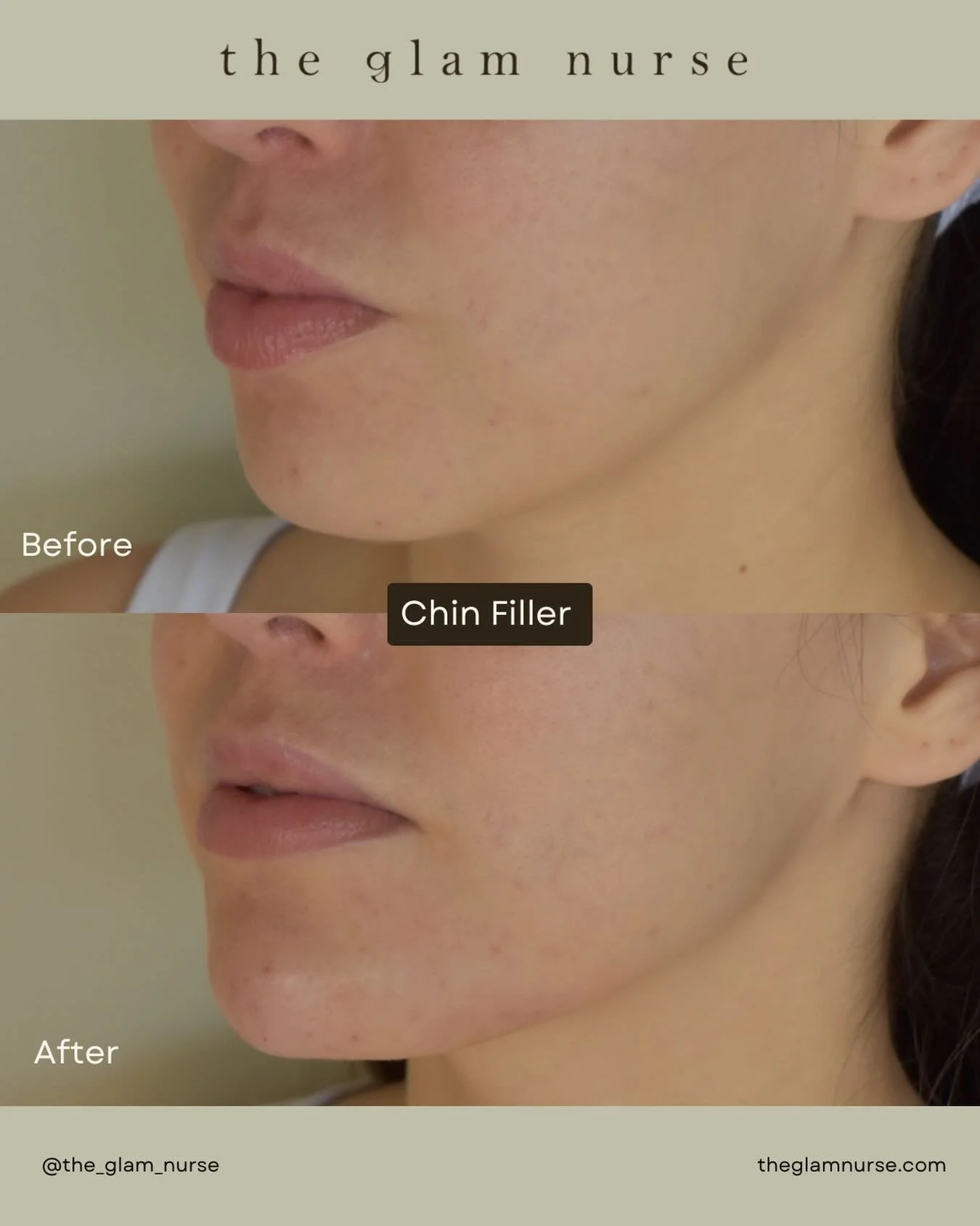 A little balance goes a long way ✨💉

By adding subtle structure to the chin, we can soften the overall profile, enhance natural harmony, and create a more balanced, feminine look&mdash;without changing what makes you you.

It&rsquo;s not about makin