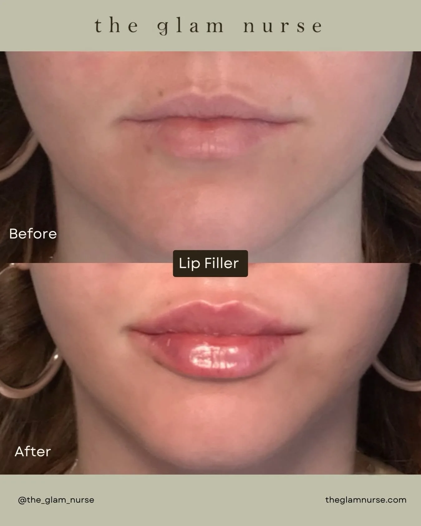 We love a gorgeous set of lippies👄💉

We are currently scheduling into May, so please plan your appointments ahead😉

Please note swelling, bruising and slight unevenness is normal and expected. Plan your appointment accordingly allowing yourself 2 