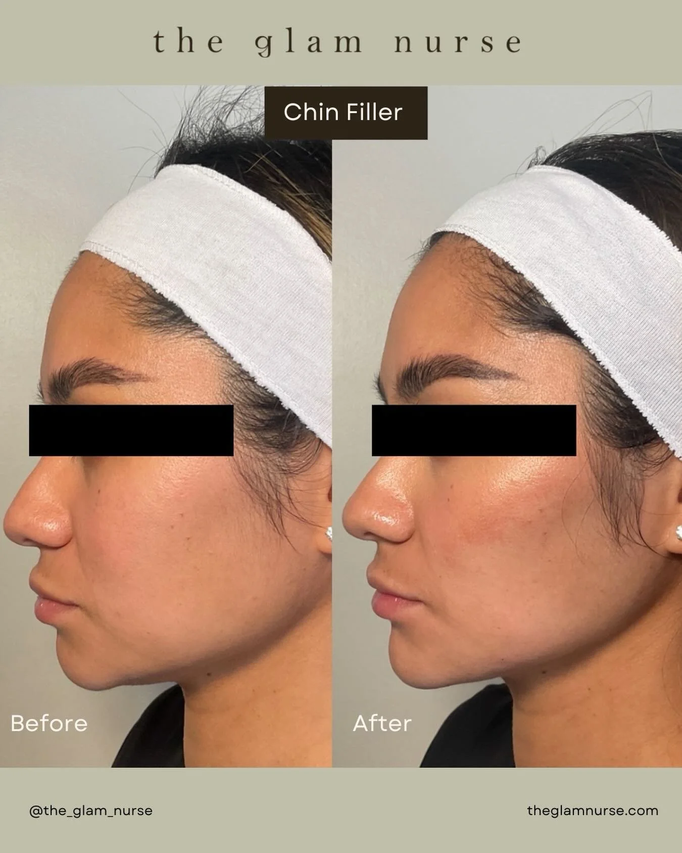 A little chin filler can make a big difference, balancing the profile, enhancing the jawline, and creating subtle harmony throughout the face ✨

We are currently scheduling into June, so please plan your appointments ahead😉

Please note swelling, br