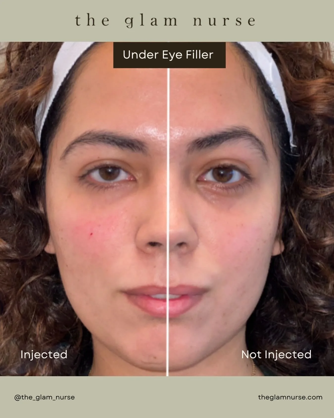 Under-eye filler can be a slippery slope, which is why the goal should never be obvious filler, just a softer, brighter, more rested appearance. When done thoughtfully and modestly, it creates the most beautiful natural refresh.✨💉🔆

A subtle correc