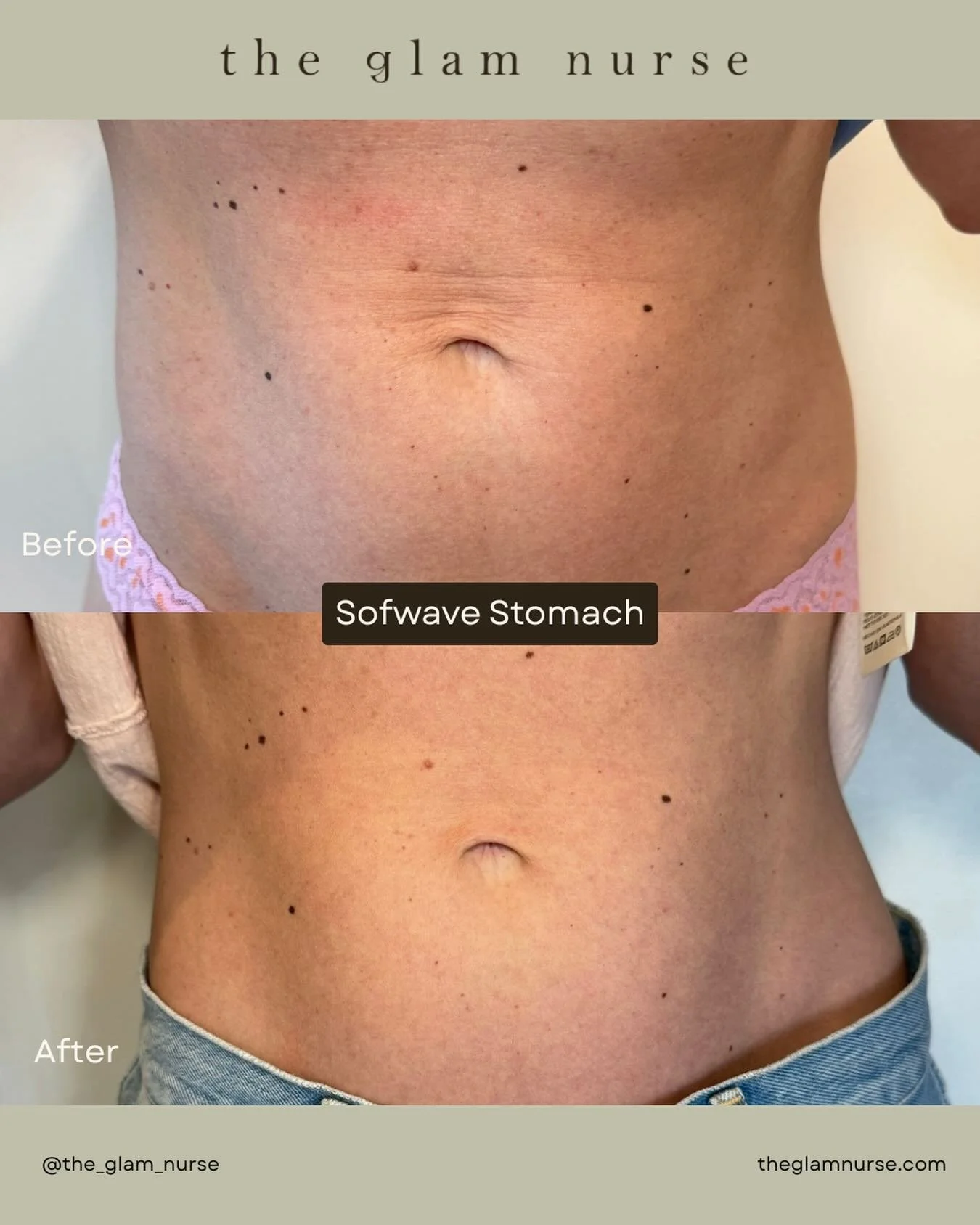 One treatment. Real results. ✨

Just ONE Sofwave&trade; session on the abdomen helped visibly soften fine lines while creating a firmer, tighter, more lifted appearance 🤌🏼

Sofwave&trade; uses clinically proven ultrasound technology to stimulate co