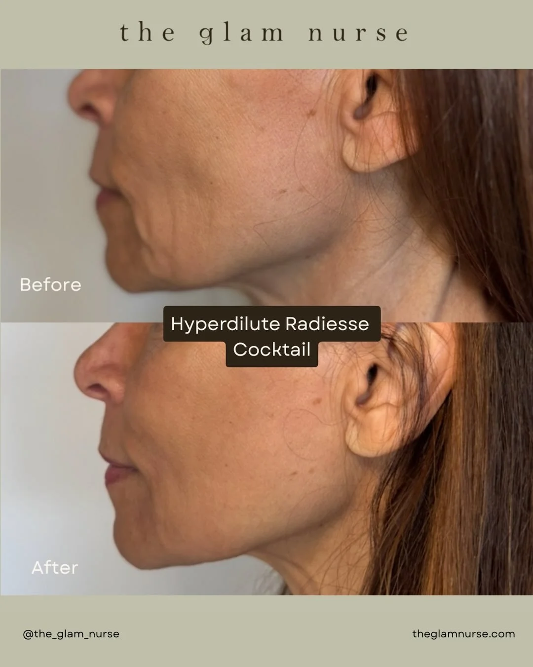 When it comes to skin rejuvenation, regenerative treatments continue to lead the way. ✨

Our Hyperdilute Radiesse&reg; cocktail delivers the best of both worlds:

✔️ Immediate visible improvement
✔️ Long-term collagen and elastin stimulation

This tr