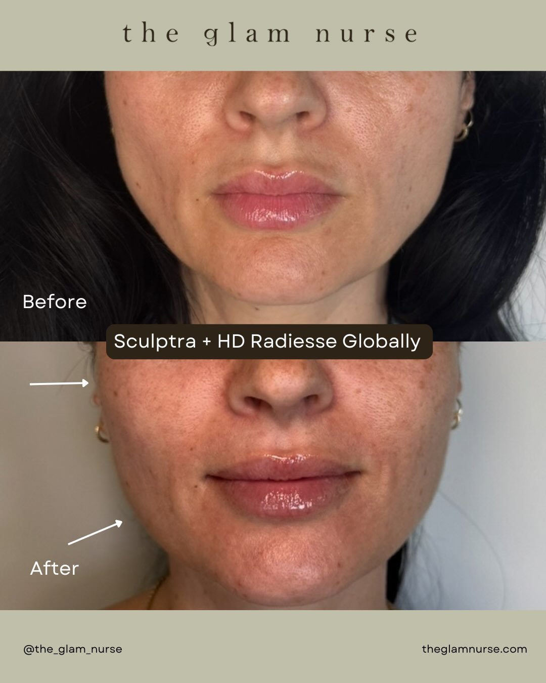 ✨ Subtle changes, strategic treatment.

This before &amp; after showcases the lower and midface following a series of treatments with Sculptra + hyperdilute Radiesse.

✨ Sculptra provided structural support and collagen stimulation, with beautiful en
