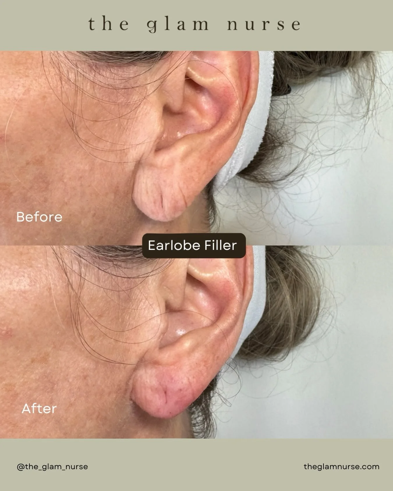 ✨ Earlobe filler: restoring support and structure

Over time, age and years of wearing earrings can lead to thinning, elongation, and loss of structural support in the earlobes.

In this before and after, strategically placed filler helps restore vol
