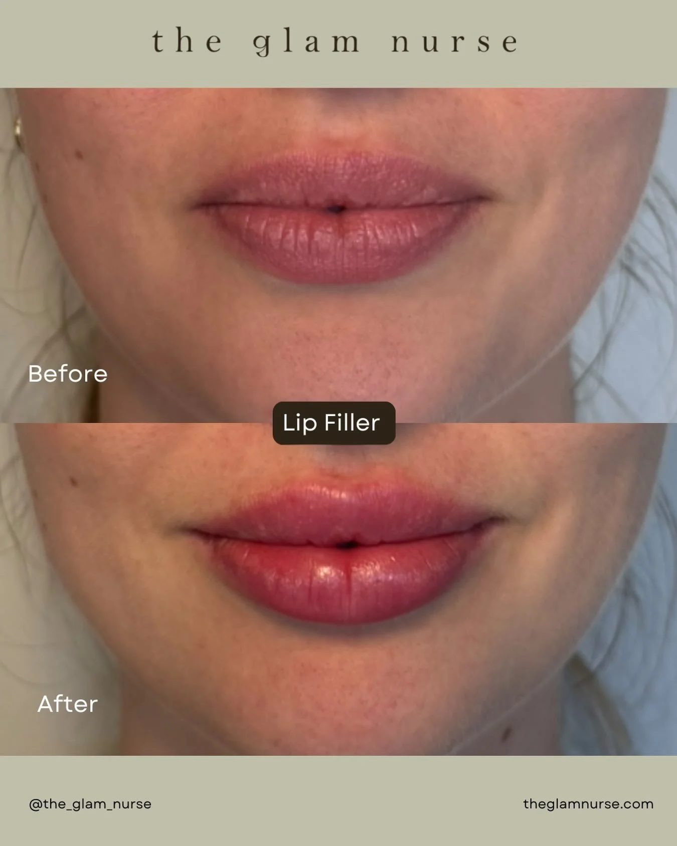 💋 Hydration meets volume. 💧✨

A little enhancement, a lot of hydration! These before &amp; after results showcase beautifully refreshed lips with added volume, improved definition, and a soft, hydrated-looking finish. 

#lips #lipfiller