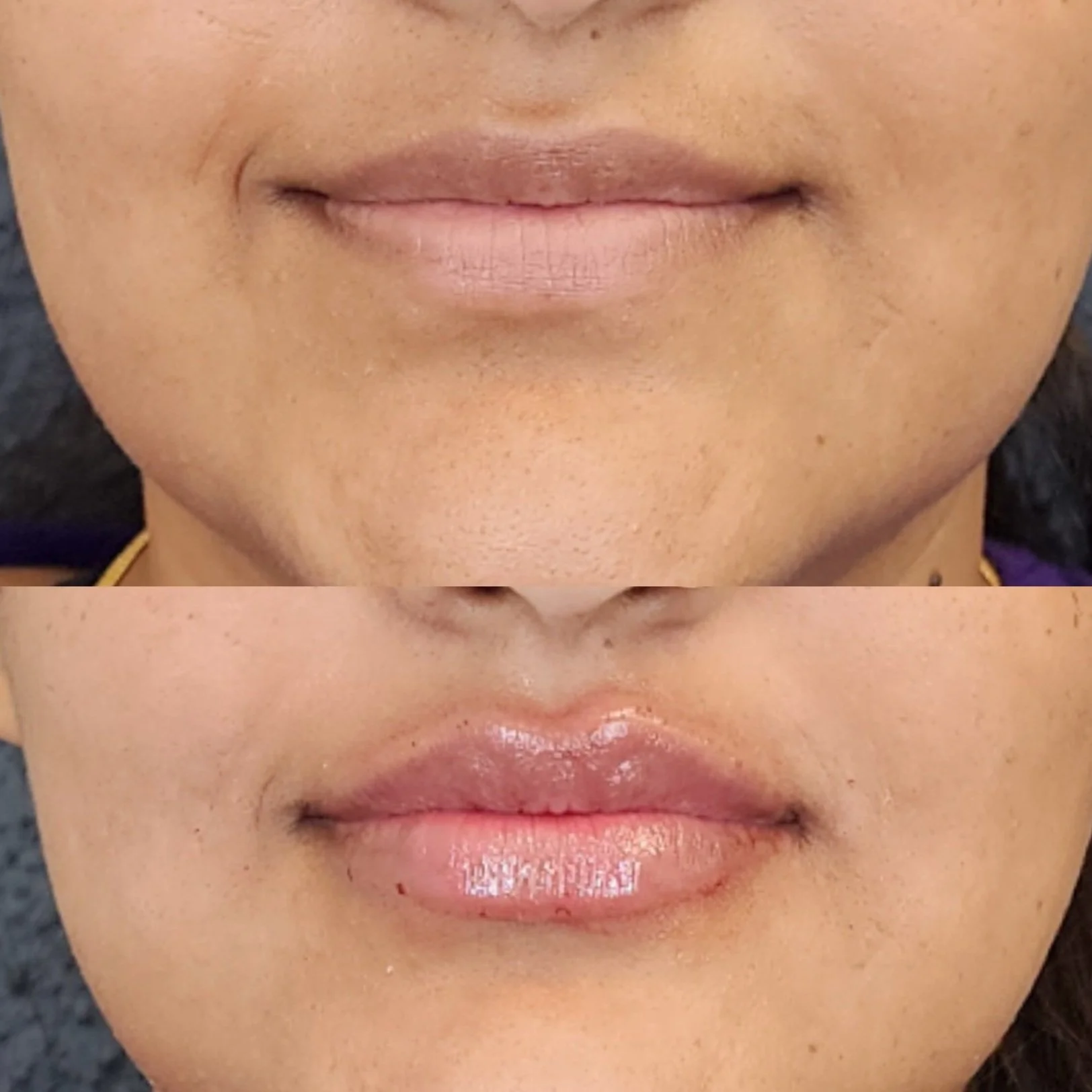 Filler: Lip