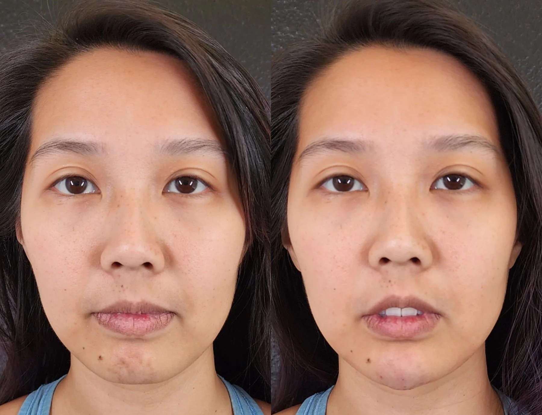 chin filler