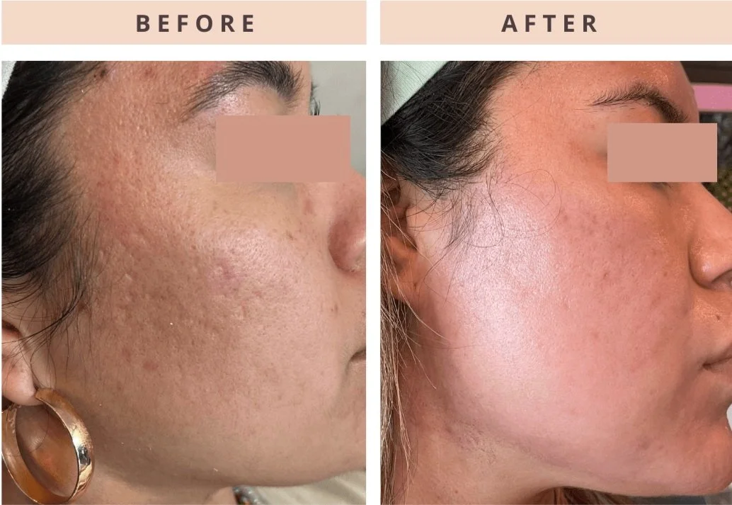 Before & After CoolPeel Acne Scars