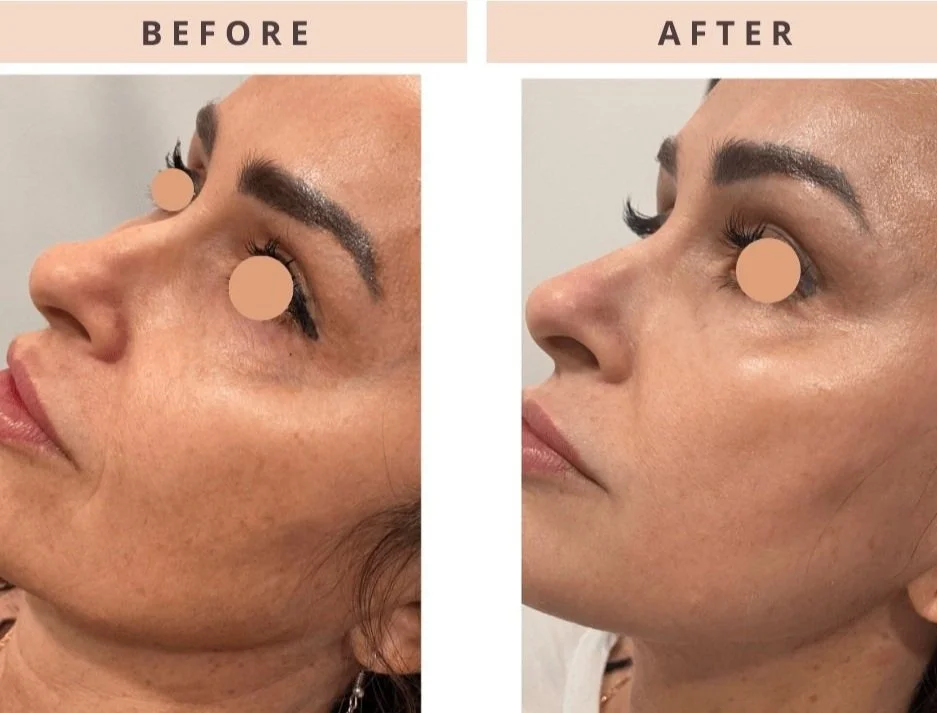Before & After CoolPeel Face