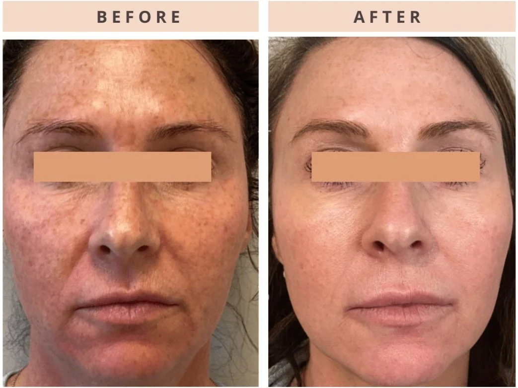CoolPeel Face Before and after image