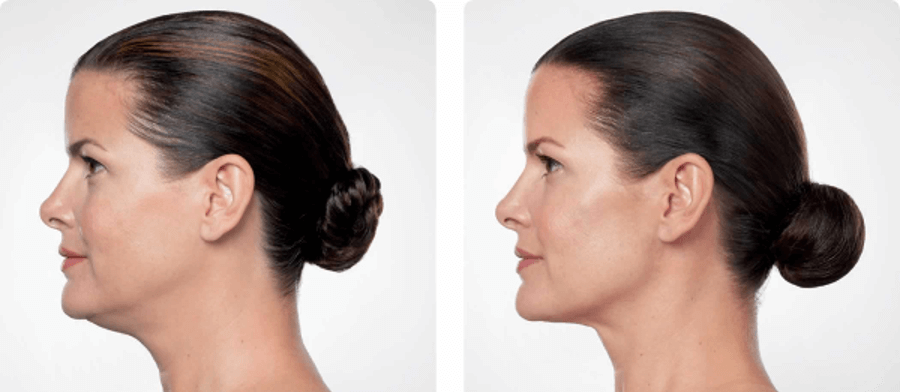 before-after-kybella