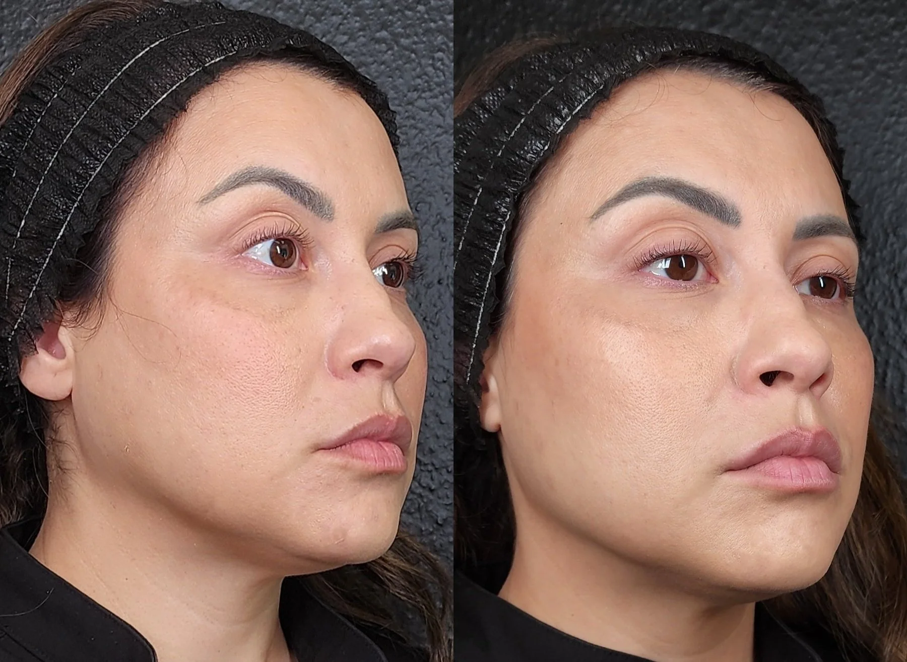 Botox: Masseters