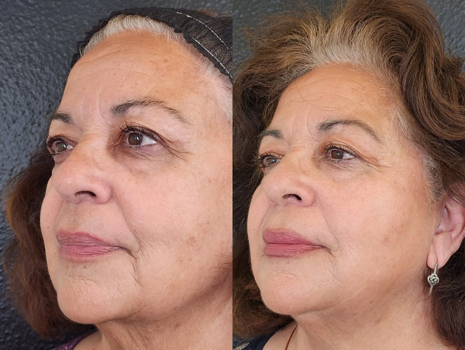 Filler: Cheeks, Chin, Nasolabial Folds, Lips