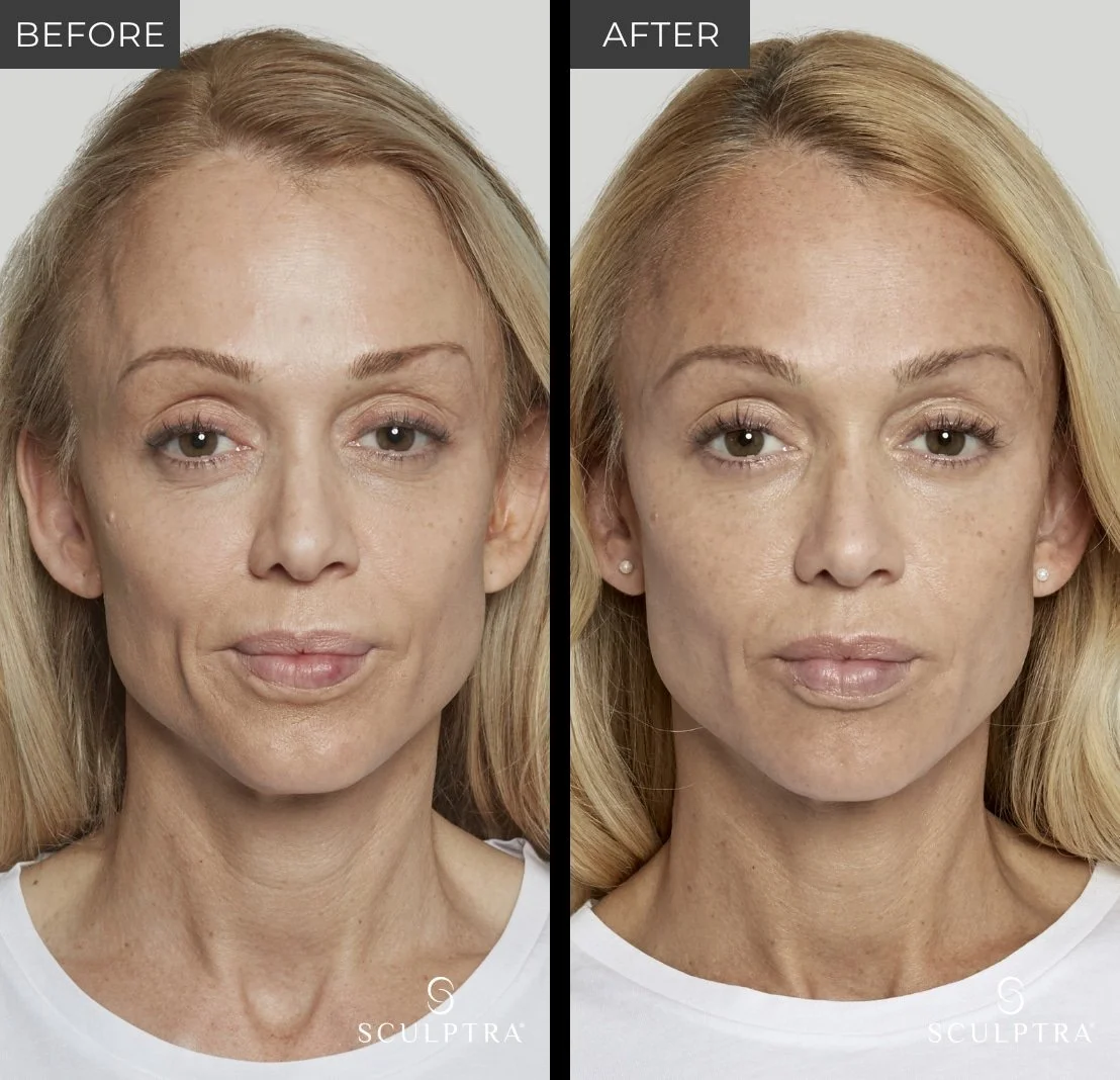 Before and after Sculptra results