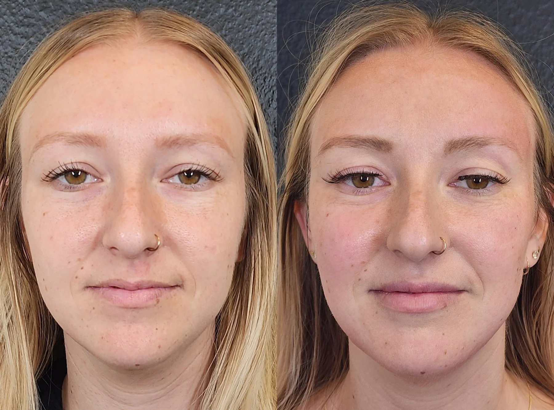 Filler: Cheeks, Lips, Chin, Jawline