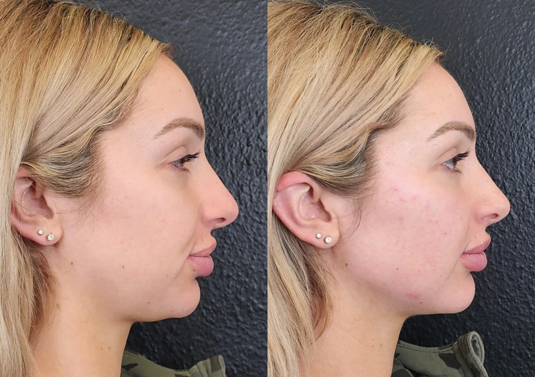 Filler: Cheeks, Chin, Jawline