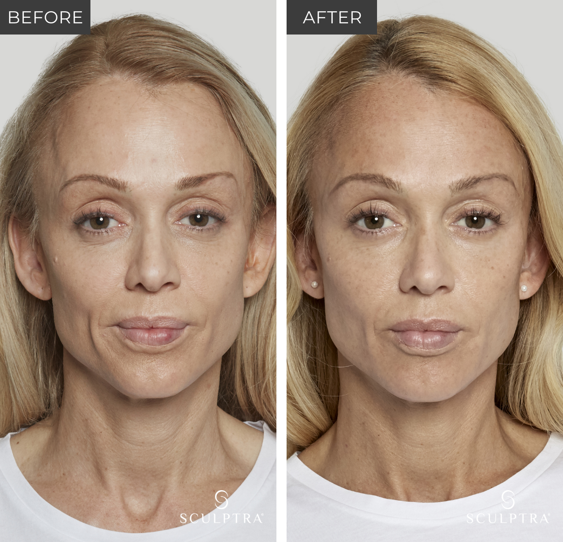Sculptra B&A