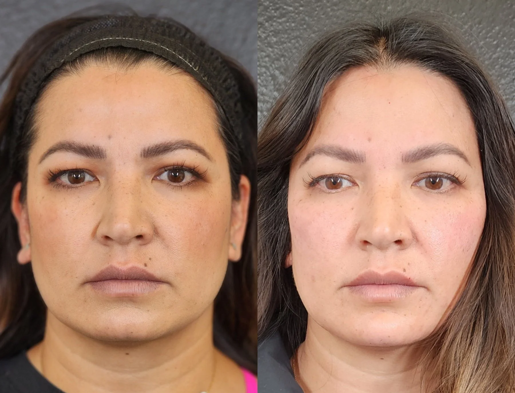 cheek and chin filler