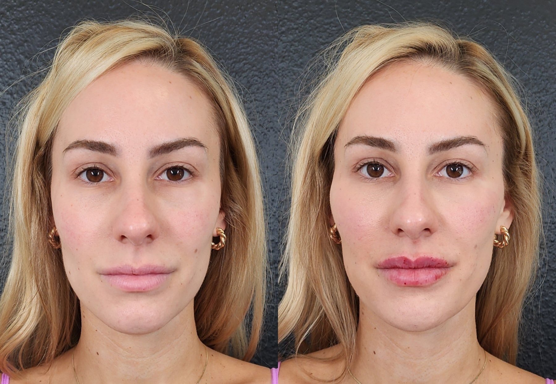 Filler: Cheeks, Chin, Jawline, Lips