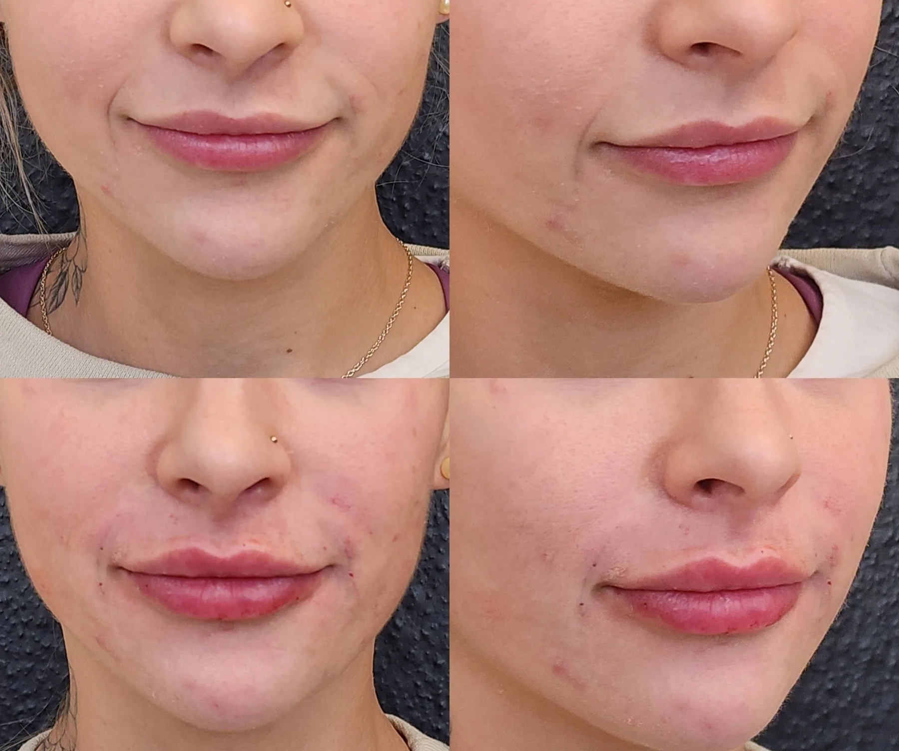 Filler: Lips, smile lines