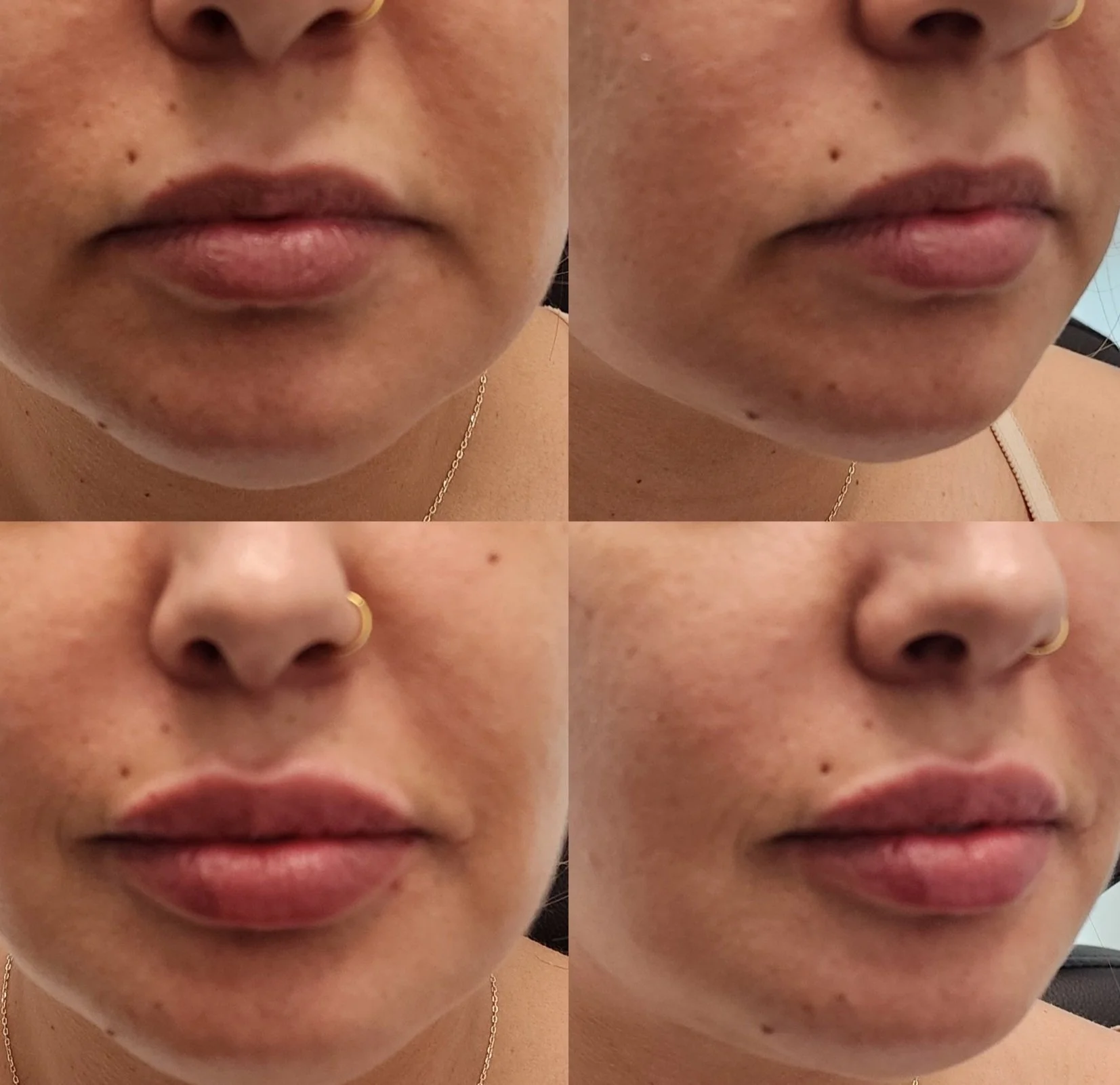 Filler: Lips