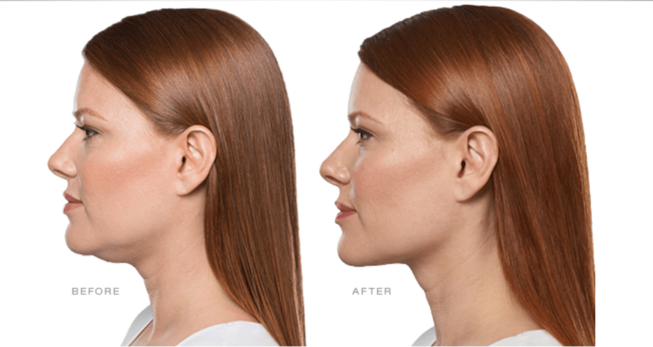 Before and after Kybella
