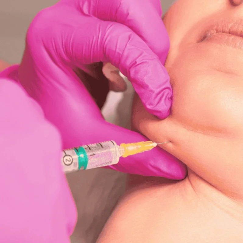 kybella double chin