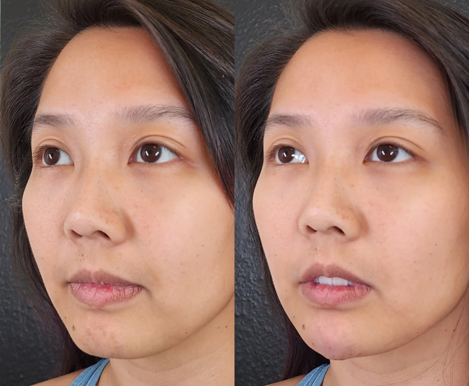 chin filler