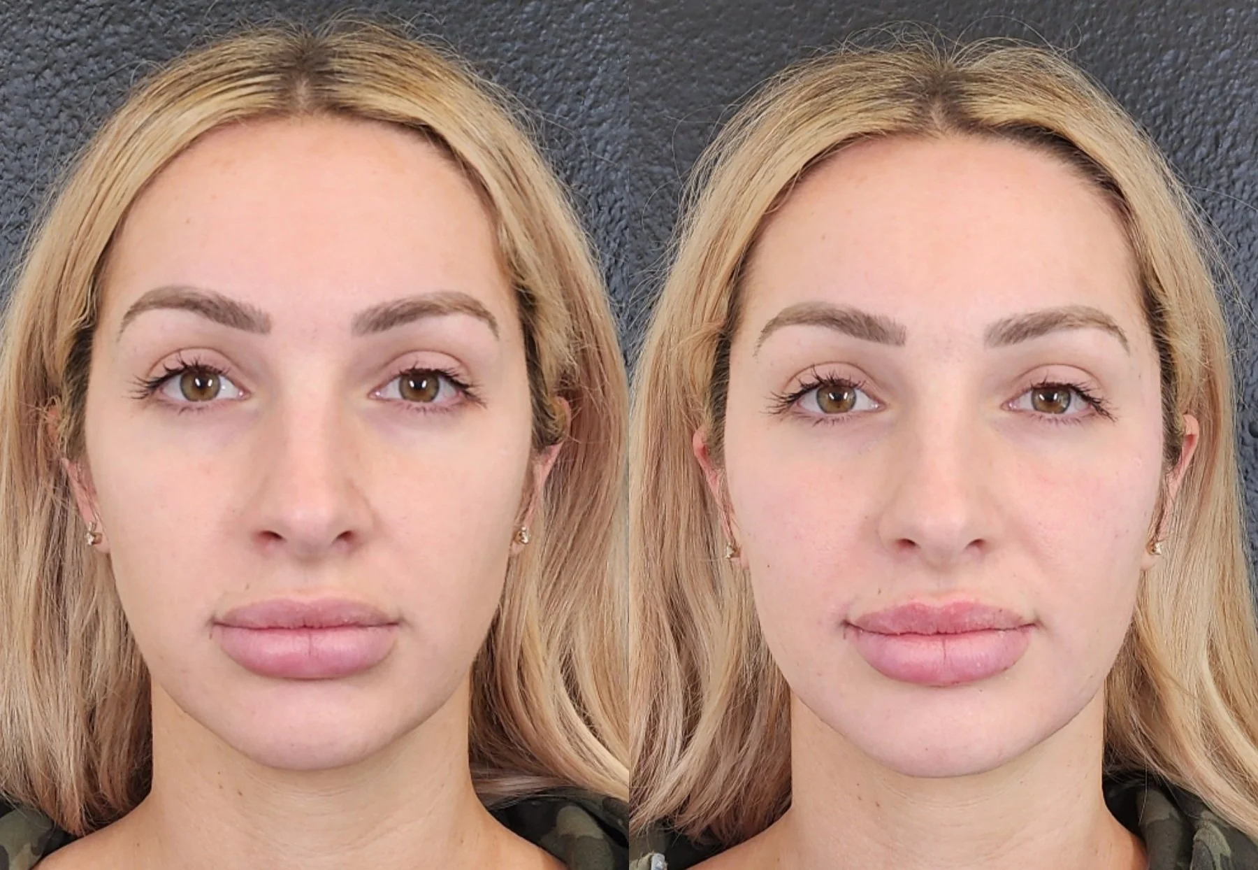 Filler: Cheeks, Chin, Jawline