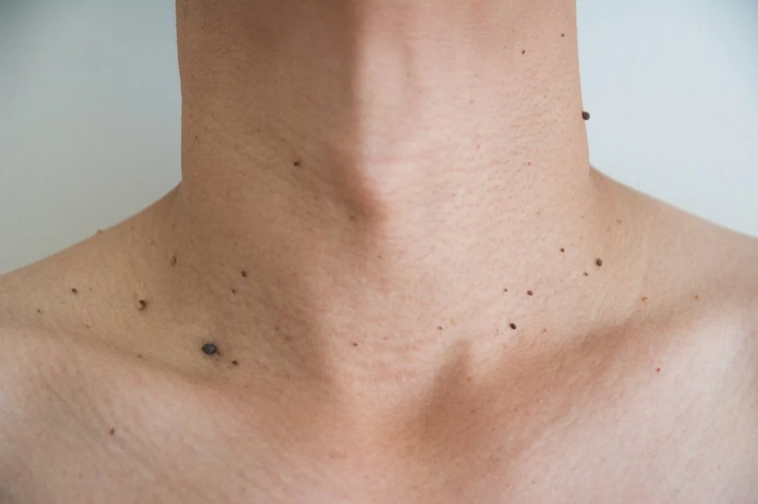 skin tags on neck