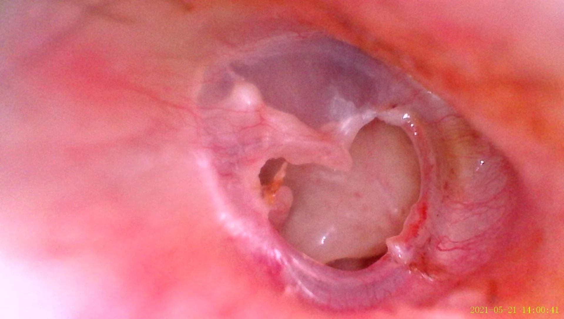 Ear Drum Reconstruction (Tympanoplasty)