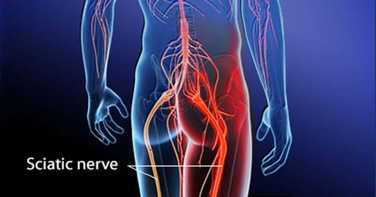 Picture of body detailing sciatic nerve