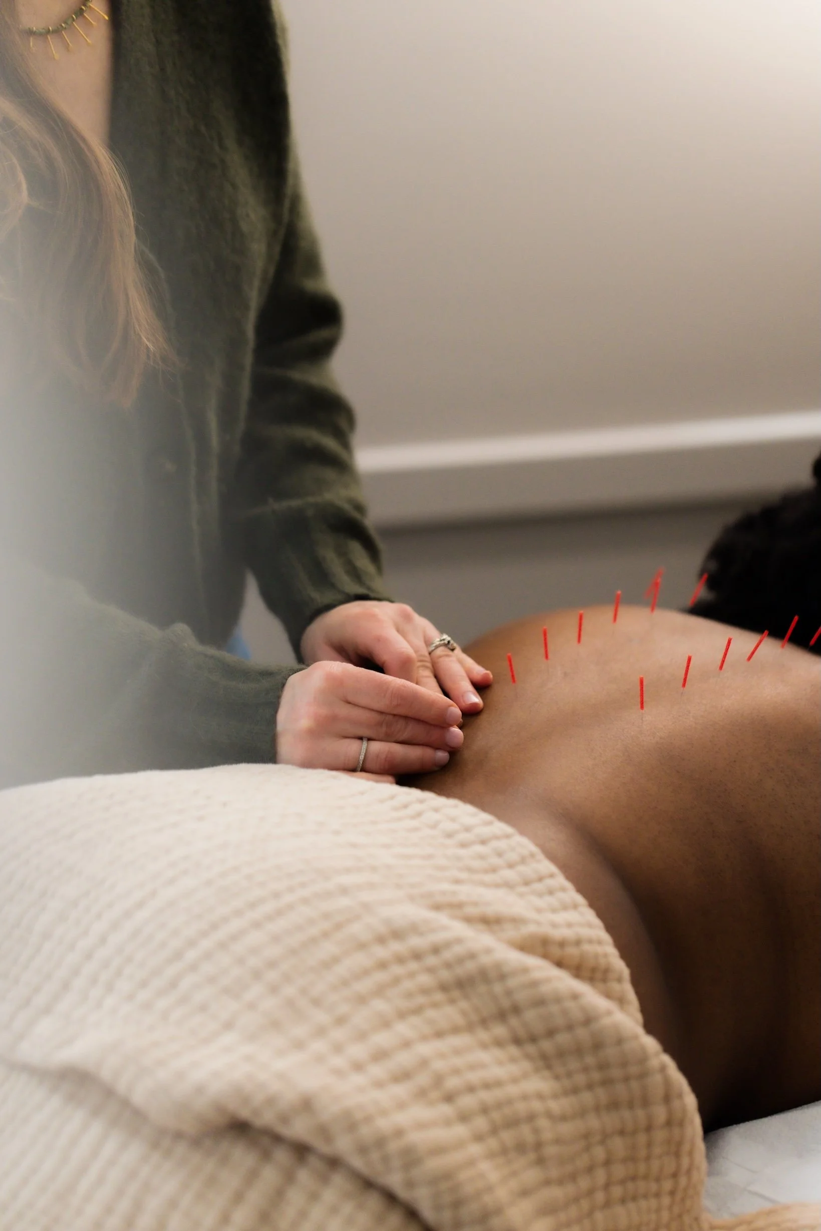 woman getting acupuncture on her back