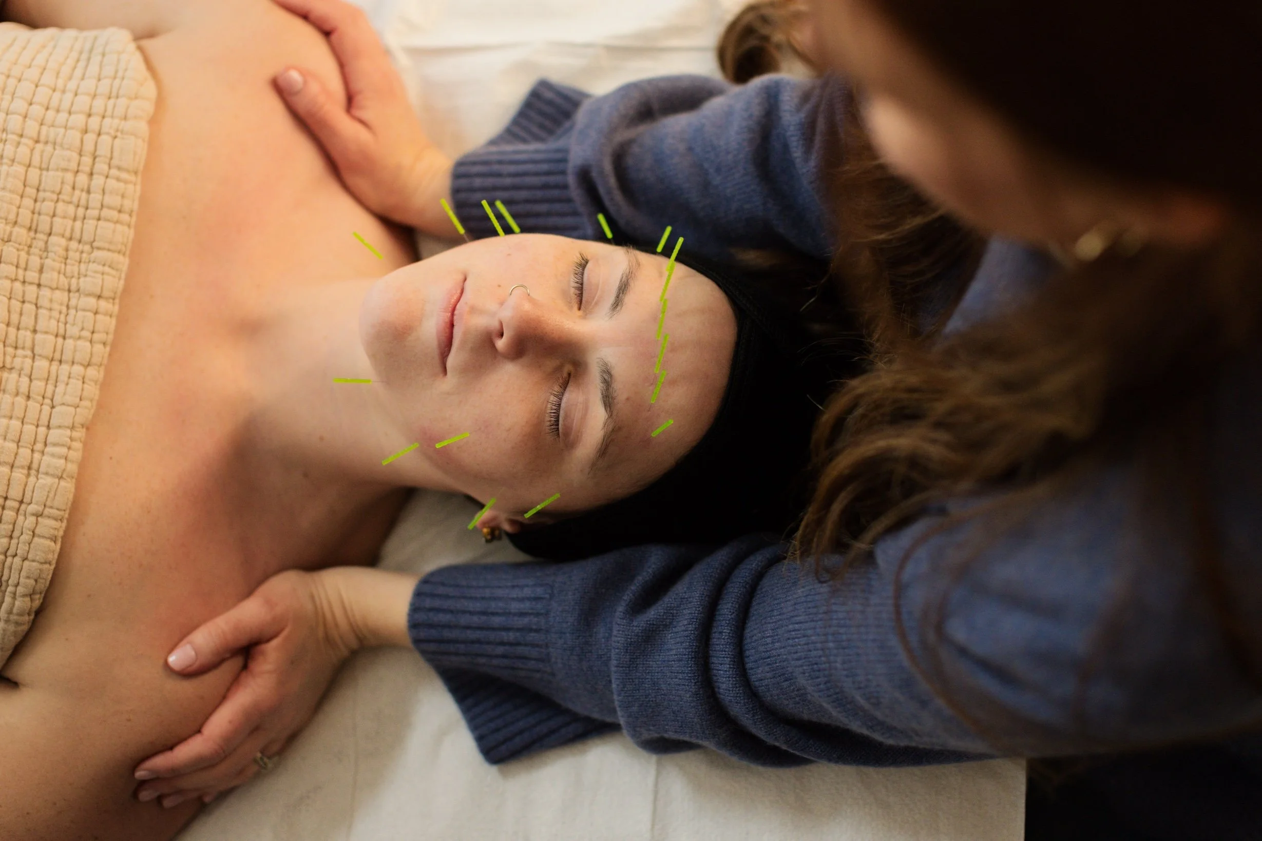 women getting cosmetic acupuncture service