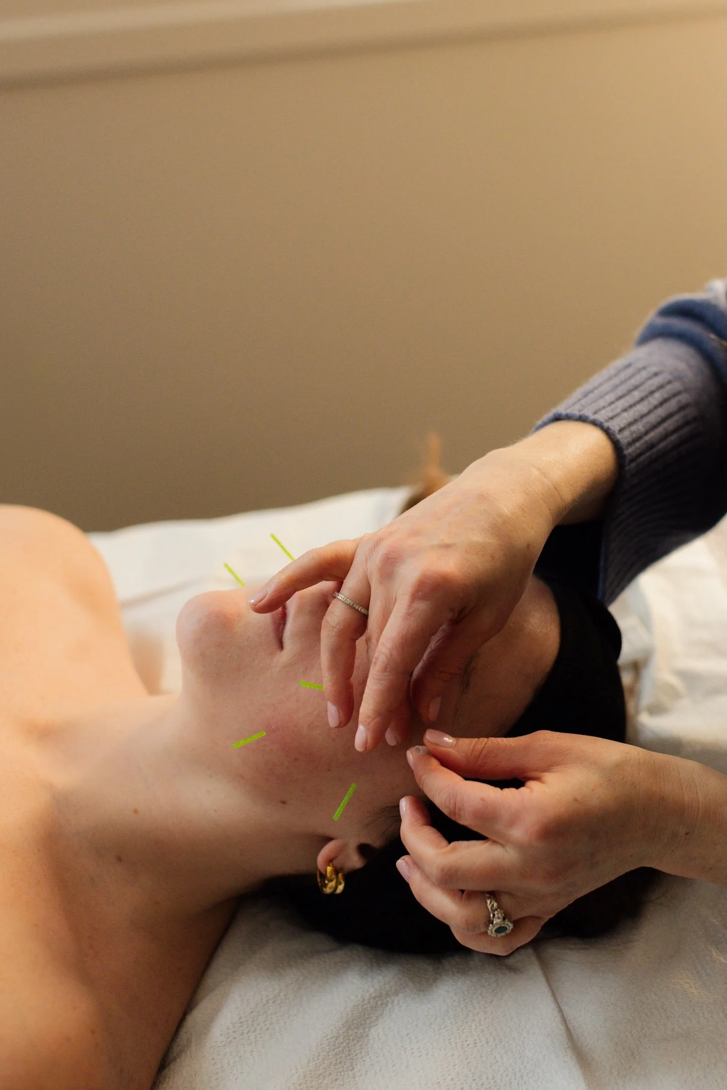 Woman getting acupuncture service