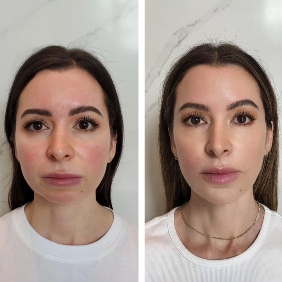 Side-by-side comparison of a woman's face before and after cosmetic treatment, showing smoother skin and enhanced facial features.